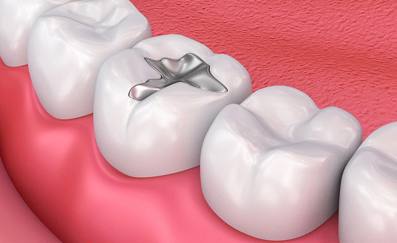amalgam fillings and white fillings taree dental care