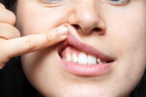Swollen Gums