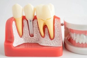 dental implants crown