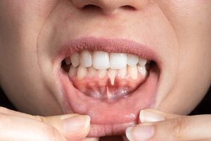Swollen Gums